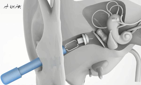 سمعک نامرئی